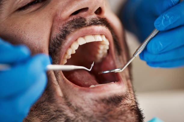 Best Chipped Tooth Repair Near Me  in Marillo, CA