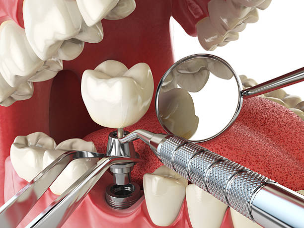 Best Knocked-Out Tooth Emergency  in Marillo, CA